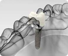 implant FAQ