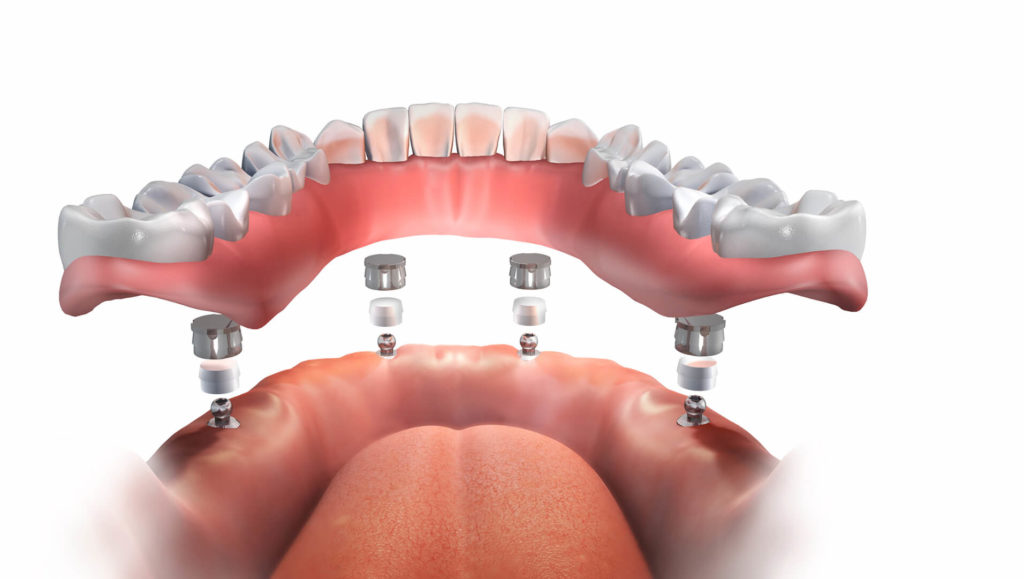 implant supported dentures