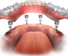 implant denture