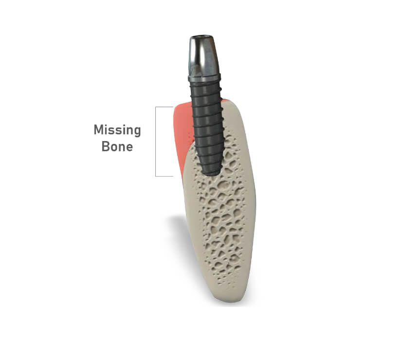 bone grafting