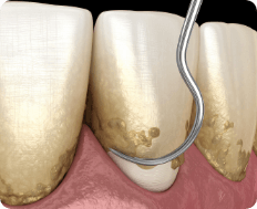 scaling and root planing