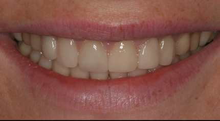 anterior implant crown lengthening after