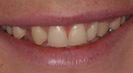 anterior implant crown lengthening before