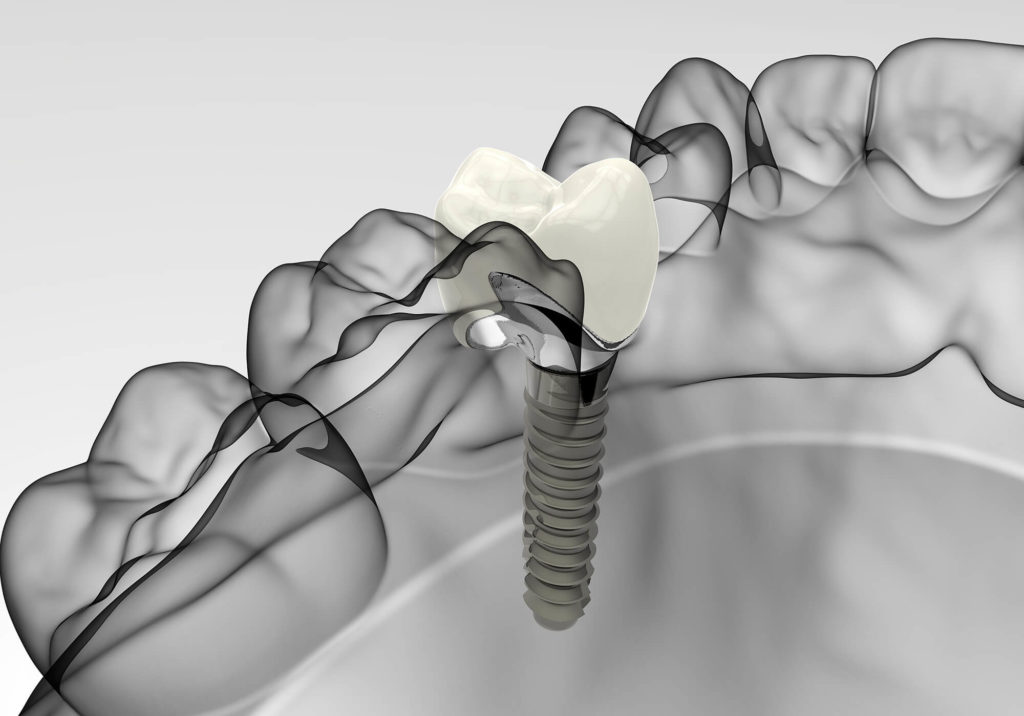 dental implant graphic